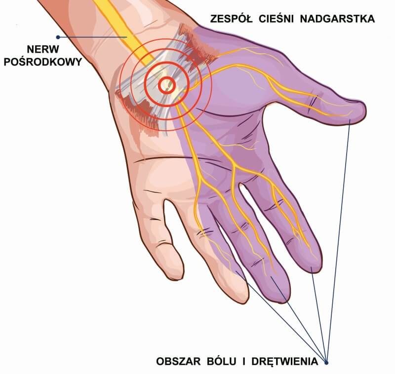 Zespół cieśni nadgarstka Co to jest Jak leczyć